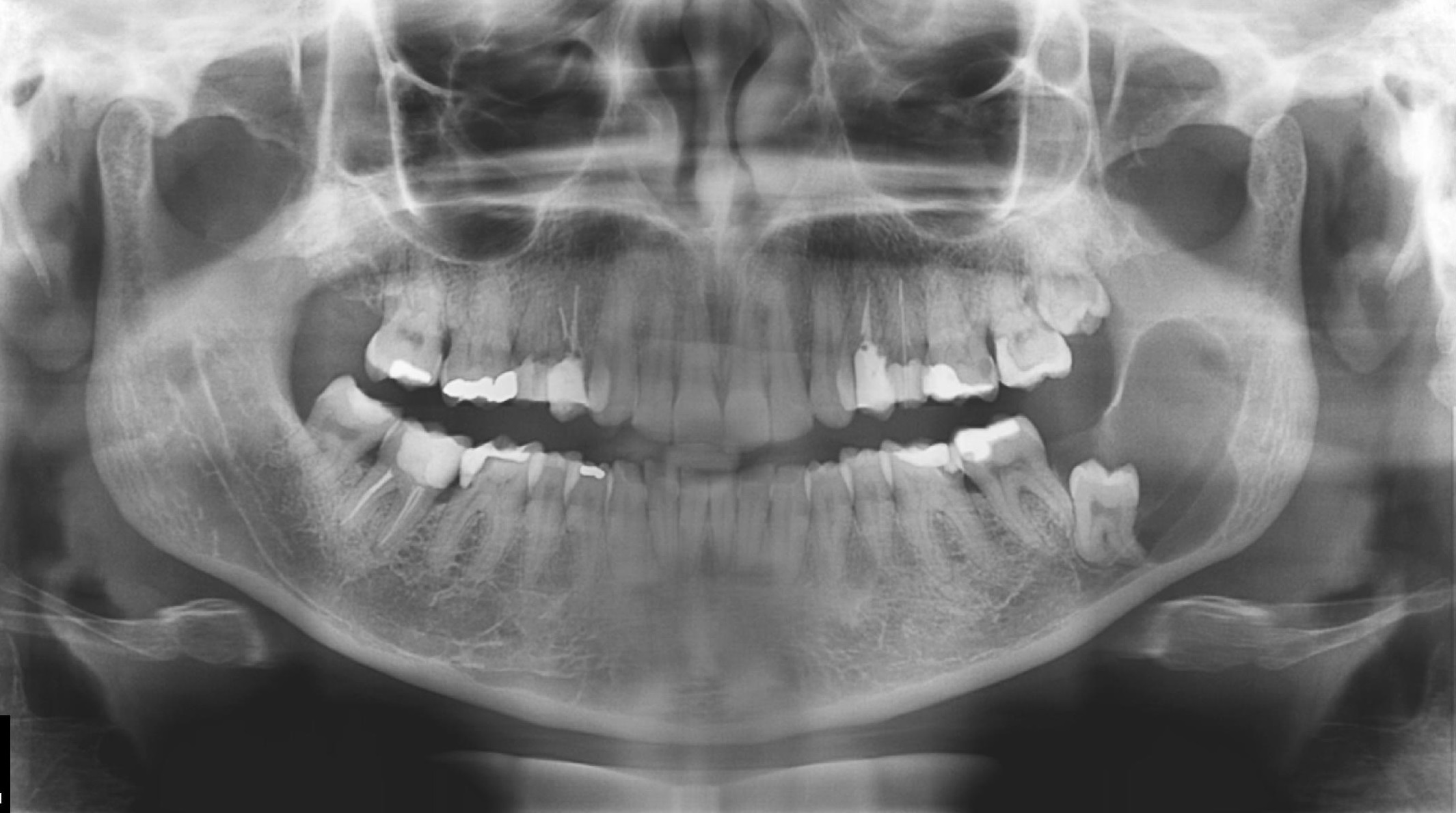 Radiografia Panorâmica da mandíbula não evidencia lesões sugestivas de