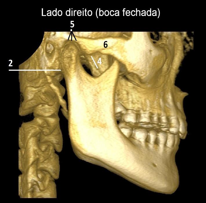 Odontocentro - A articulação temporomandibular (ATM) funciona como uma  dobradiça que liga a mandíbula ao crânio. Esta disfunção pode causar dor e  desconforto. 😰😰 Dores no maxilar, dificuldade de mastigar e estalos