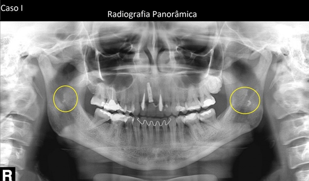 Notar radiopacidades projetadas em ambos os ramos da mandíbula (destacadas pelo circulo amarelo) – Imagem compatível com calcificação de ambas as tonsilas palatinas