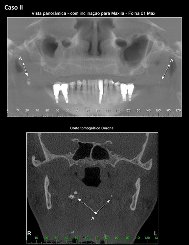 Legenda para as imagens do Caso II – Notar nódulos hiperdensos localizados em região de tonsila palatina em ambos os lados, letra A - Tonsilólitos