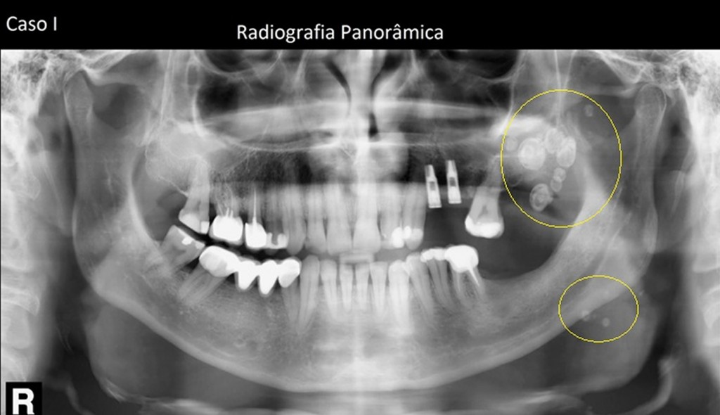 Observa-se diversos nódulos radiopacos projetados ao processo alveolar, túber da maxila, seio maxilar e em partes moles do terço inferior da face: flebólitos.