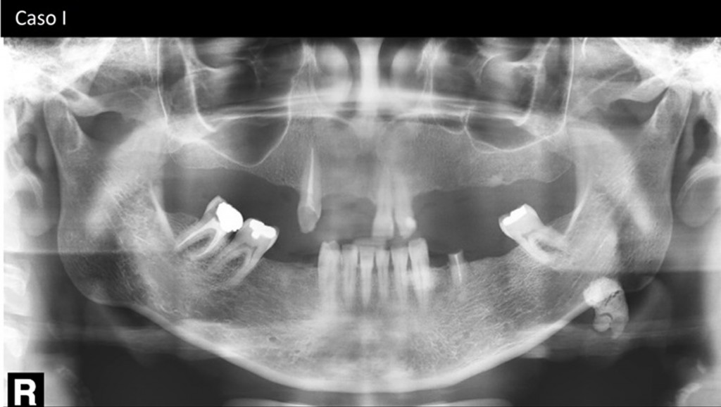 Legenda para o caso I - Massa radiopaca projetada em região de fóvea submandibular/ângulo da mandíbula, lado esquerdo compatível com sialólito da glândula submandibular.