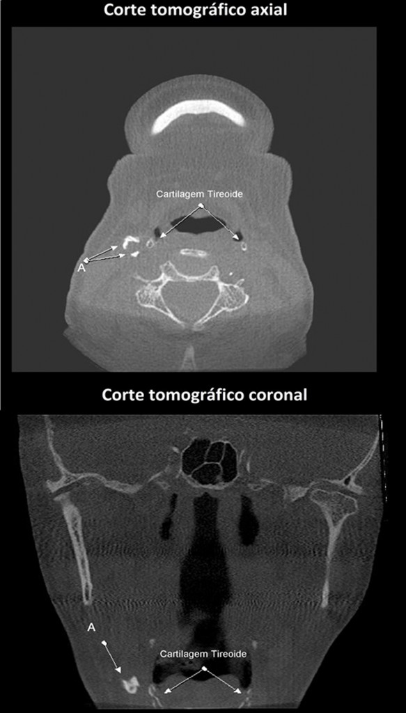 Os cortes tomográficos axial e coronal mostram imagem hiperdensa de aspecto tubular em espaço carotídeo, lado direito, em proximidade com a cartilagem tireoide (mineralizada); imagem sugestiva de ateroma de artéria carótida, letra A.