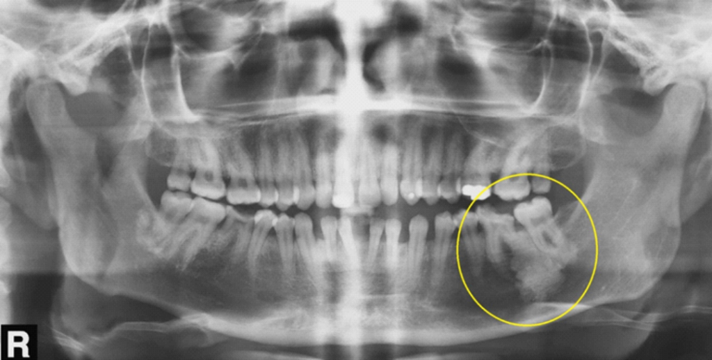 Imagem radiopaca observada em periápice dos dentes 36 e 37 (notar destruição da porção coronária da unidade 36 e da reabsorção radicular externa de sua raiz distal). Apesar de a radiopacidade mostrar-se extensa, os espaços pericementários, tanto da raiz distal do dente 36 quanto das raízes do dente 37,  podem ser observados, o que sugere OES. No entanto, um acompanhamento clínico-radiográfico se faz necessário.