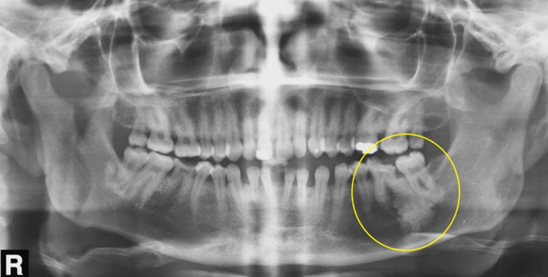 Osteomielites do complexo Maxilo Mandibular – Papaiz Diagnósticos  Odontológicos por Imagem