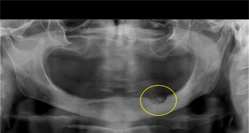 Caso I - Radiografia panorâmica : nota-se imagem de densidade mista em processo alveolar da mandíbula (região correspondente aos dentes 35 e 36). Clinicamente, observa-se fístula na região de rebordo alveolar, o que sugere Osteomielite Supurativa Crônica, (OSC).