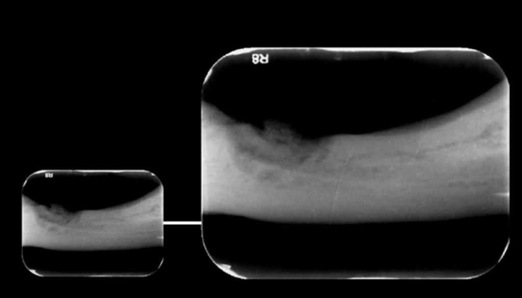 Caso I - A radiografia periapical mostra com mais nitidez a imagem de densidade mista em região correspondente aos elementos 35 e 36, sugerindo Osteomielite Supurativa Crônica, (OSC).