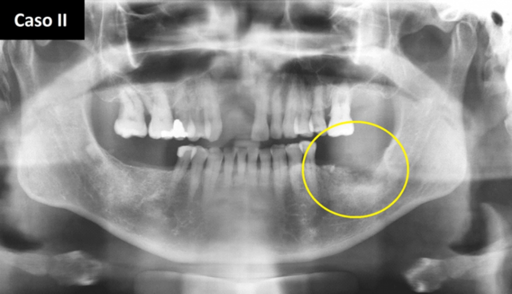 Caso II – A radiografia panorâmica nos mostra imagem de densidade mista, de limites difusos, em processo alveolar da mandíbula, em região correspondente aos dentes 36, 37 e 38, sugerindo Osteomielite Supurativa Crônica , (OSC).