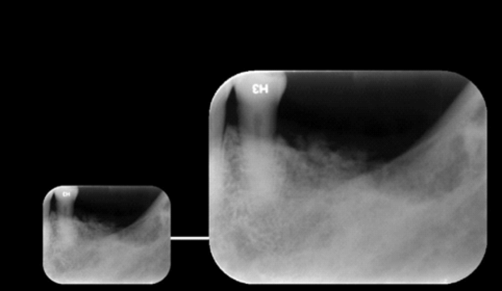 Caso II - A radiografia periapical mostra em detalhes, a imagem de densidade mista e limites difusos em região correspondente aos elementos 36, 37 e 38, sugerindo Osteomielite Supurativa Crônica, (OSC).