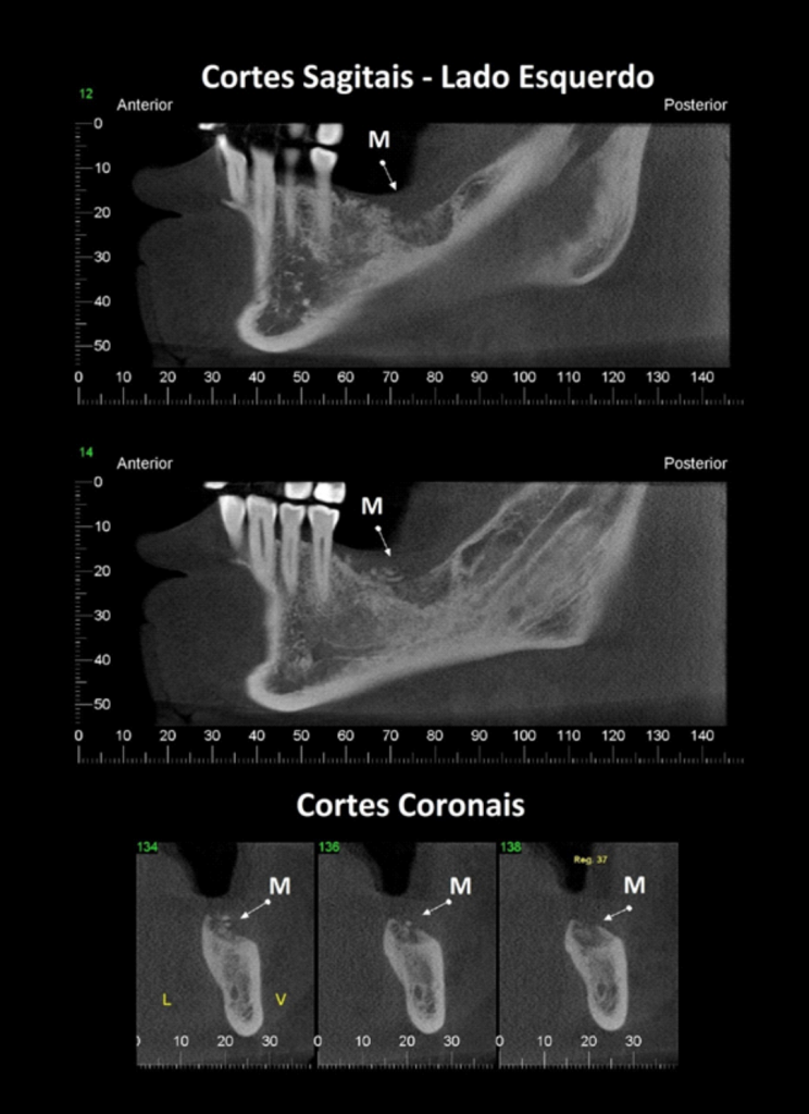 Caso II – Cortes sagitais e cortes coronais. O item M indica imagem de densidade mista de limites difusos em região de processo alveolar; próximo à crista óssea alveolar notamos imagens hiperdensas sugerindo sequestros ósseos.