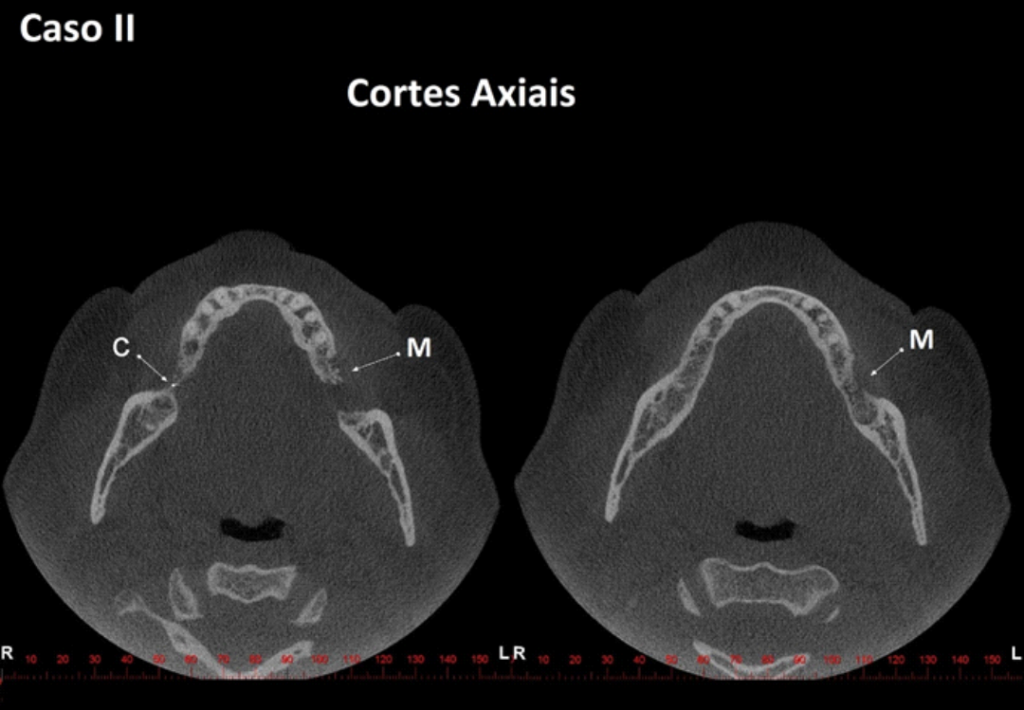 Caso II – Cortes axiais. O item M indica imagem de densidade mista de limites difusos em região de processo alveolar; próximo à crista óssea alveolar notamos imagens hiperdensas sugerindo sequestros ósseos. O item C indica corpo estranho.