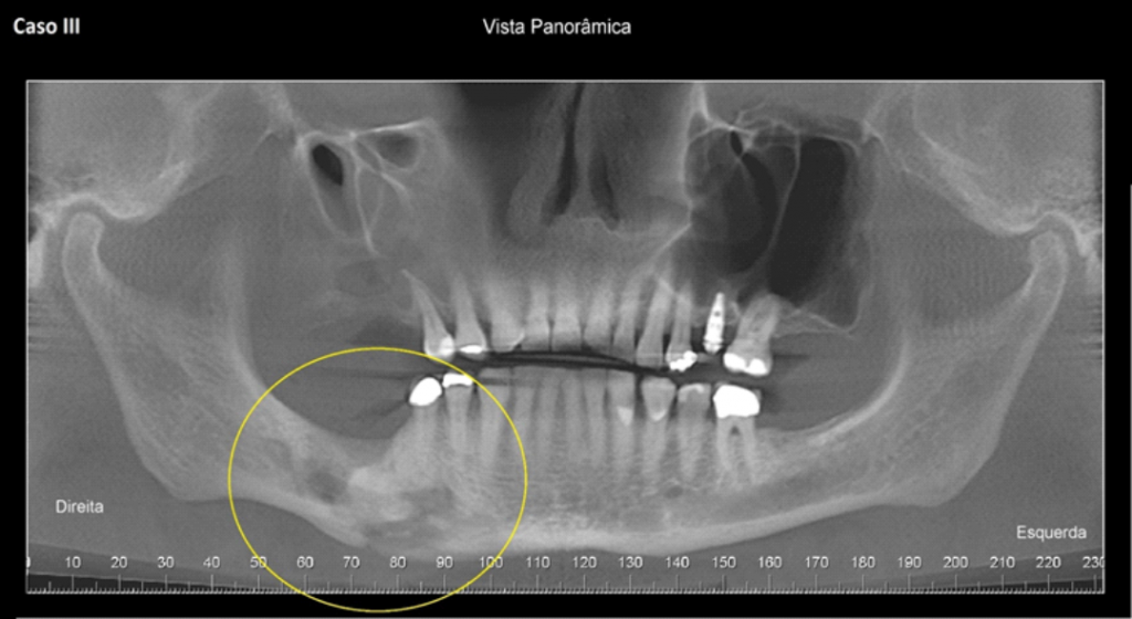 Caso III – Vista panorâmica. Notar extensa imagem hipodensa de limites difusos acometendo o processo alveolar da mandíbula em região dos dentes 47 e 46 e estendendo-se para o corpo (próxima aos dentes 45 e 44) 