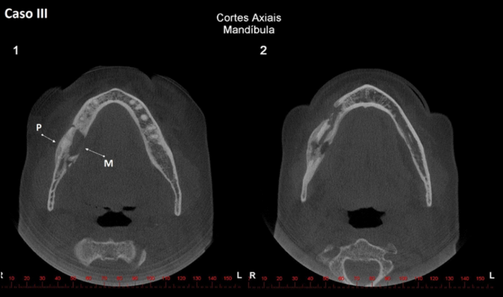 Caso III – Os cortes axiais mostram a hipodensidade difusa (item M) entremeando grande parte do processo alveolar e corpo da mandíbula, lado direito. O item P indica a reação periosteal da cortical vestibular.