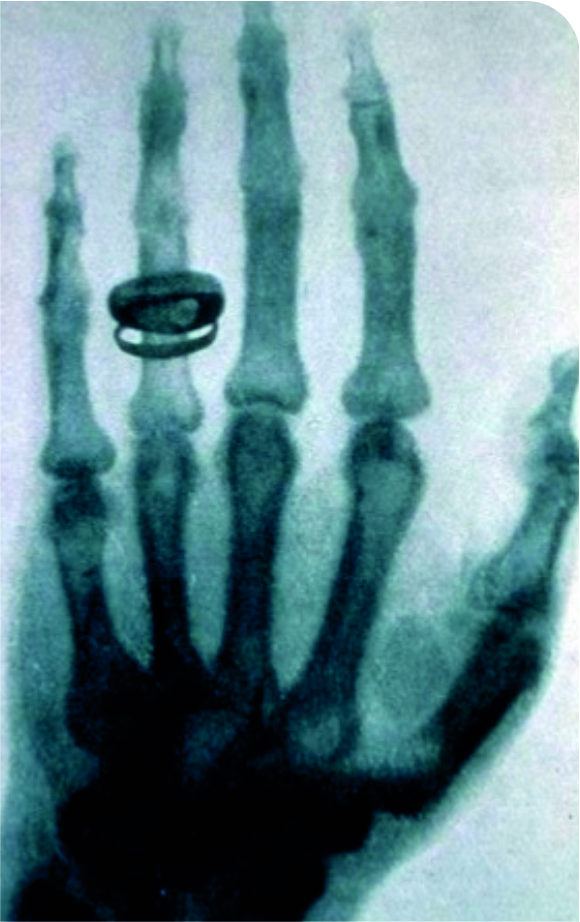 Radiografia da mão da esposa de Roentgen, apresentada em seu primeiro artigo sobre os Raios X