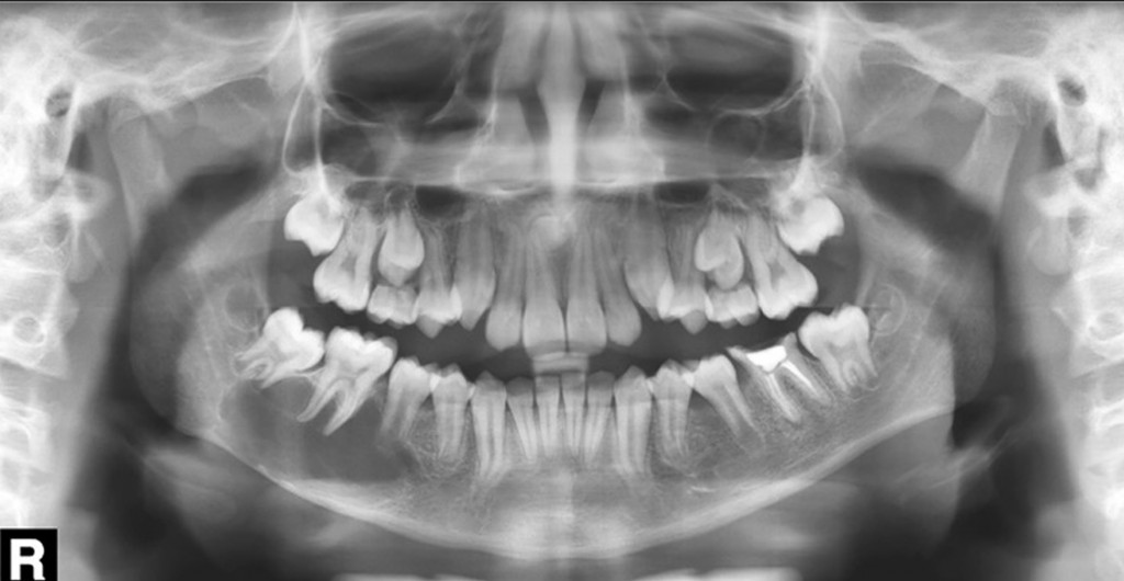 Paciente do gênero masculino, 12 anos de idade. Em corpo e processo alveolar da mandíbula, ao lado direito, notamos imagem radiolúcida de limites parcialmente definidos e corticalizados; notamos a interdigitação da área radiolúcida por entre os dentes 45, 46 e 47 – imagem compatível com COT.