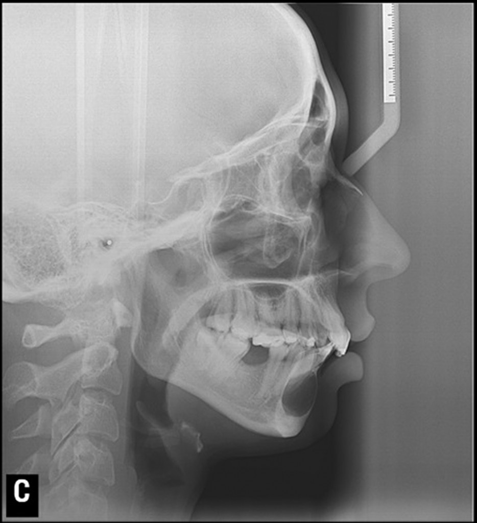 Paciente do gênero feminino, 25 anos de idade. Por meio da radiografia panorâmica, verificamos extensa imagem radiolúcida acometendo sínfise da mandíbula, estendendo-se do dente 44 até próximo ao dente 34. Por meio da telerradiografia em norma lateral, constatamos discreto abaulamento com adelgaçamento da cortical vestibular do processo alveolar da mandíbula. Imagem compatível com COT.