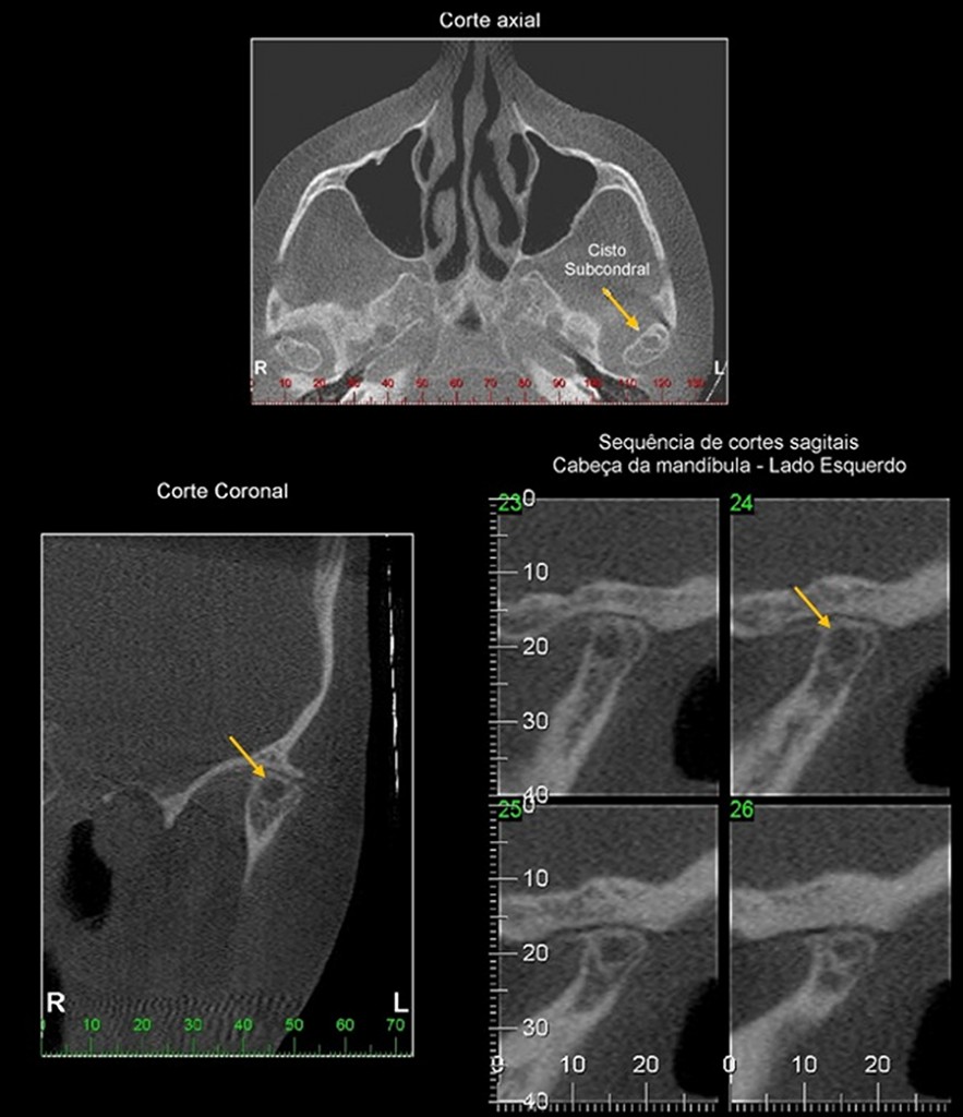 Paciente do gênero feminino, 63 anos. Cisto subcondral: imagem hipodensa, de limites corticalizados presente no osso medular da cabeça da mandíbula, do lado esquerdo.