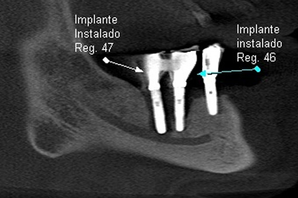 Paciente do gênero masculino, 61 anos. Cortes tomográficos de  implantes instalados nas regiões correspondentes aos dentes 47 e 46; verificamos imagem hipodensa periimplantar, compatível com rarefação óssea (periimplantite); parte do teto do canal da mandíbula não pode ser observado.