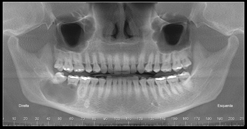Osteomielites do complexo Maxilo Mandibular – Papaiz Diagnósticos  Odontológicos por Imagem