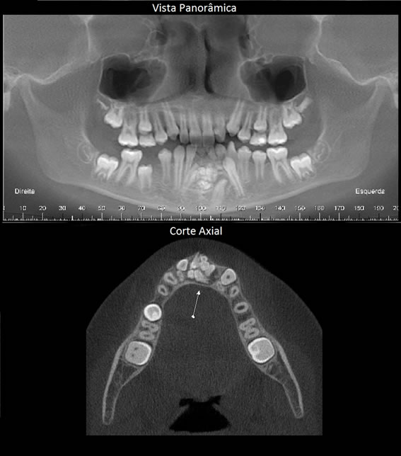Odontoma e suas classificações atuais – XVII – Papaiz Diagnósticos  Odontológicos por Imagem