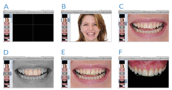 Software de apresentação de slide (Keynote, iWork, Apple) com a “cruz” no cento do slide(A). Foto facial em sua posição de harmonia em relação à cruz(B). Transferindo a cruz para o sorriso (C). Simulação dental básica(D). As três linhas de transferência para calibragem da foto intraoral(E). Foto intraoral calibrada(F)