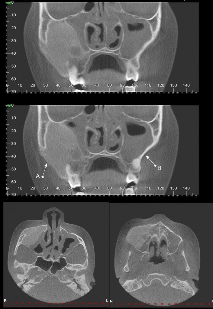 Caso II – Imagem de densidade mista (padrão marmóreo), predominamente hiperdensa, em processo alveolar da maxila e corpo de maxila, invadindo o seio maxilar correspondente (SETA A). Displasia Fibrosa. Nota-se obliteração sinusal parcial do seio maxilar ao lado esquerdo (SETA B)