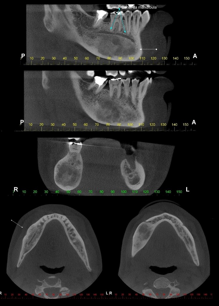 Caso III - Imagem de densidade mista em processo alveolar e corpo da mandíbula, lado direito. Notar aumento de volume das corticais vestibular, lingual e da base da mandíbula adjacentes; há, ainda, deslocamento da trajetória do canal da mandíbula em direção à crista óssea alveolar. Displasia Fibrosa.