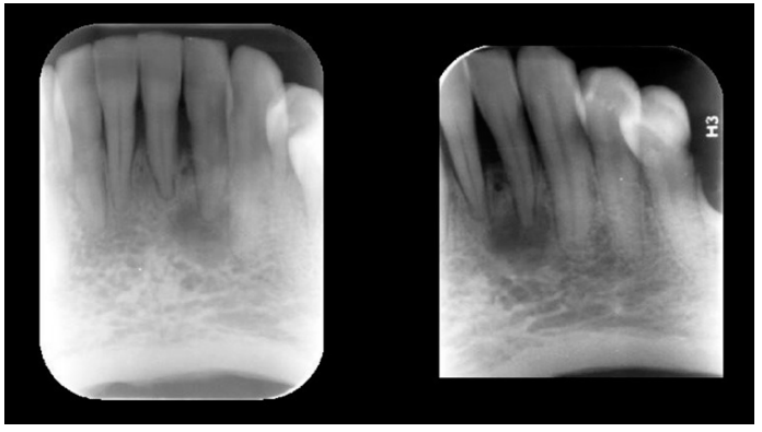 Imagem radiolúcida envolvendo a região periapical correspondente ao dente 32 – notar a integridade de sua porção coronária. DCOP Fase 1ª (osteolítica)