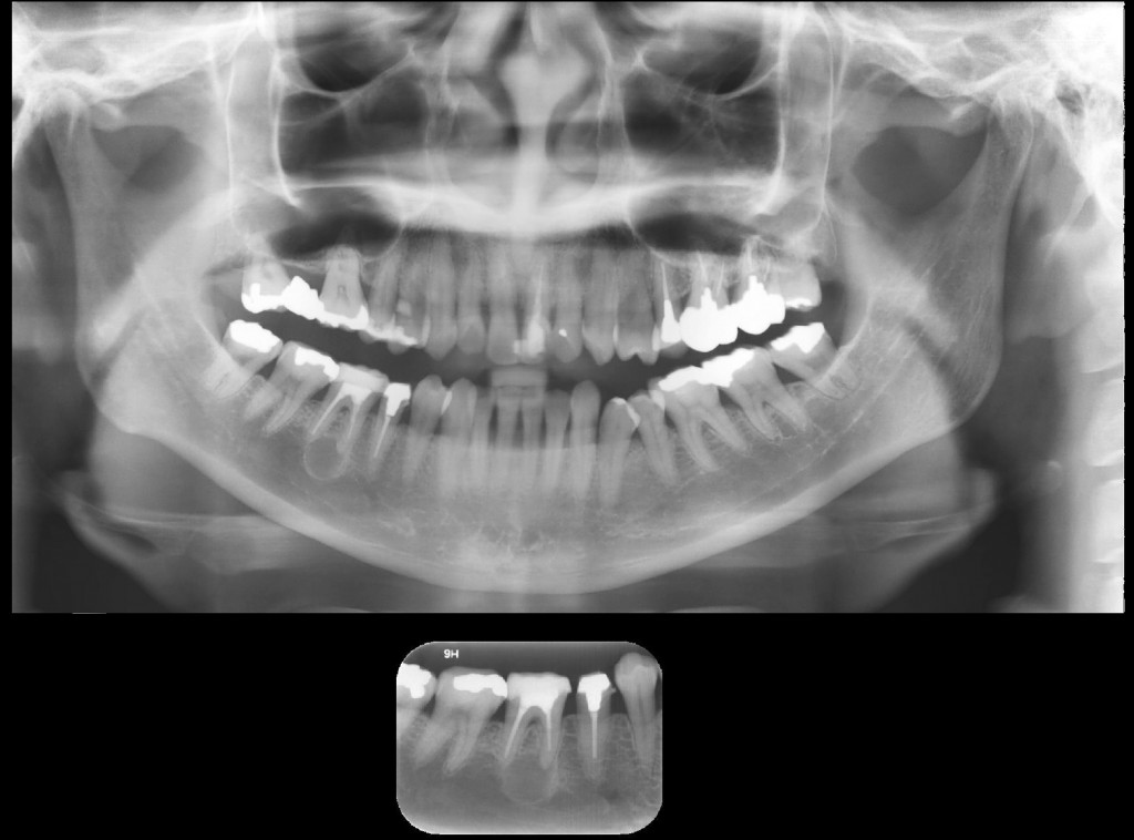 Imagem radiolúcida, circunscrita, de limites definidos e corticalizados, unilocular, envolta por halo radiopaco, associada ao ápice do dente 46 – Cisto Periapical.