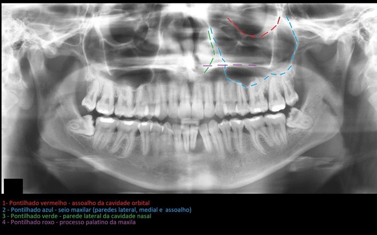 Anatomia maxila e mandibula - anatomia maxila e mandibula