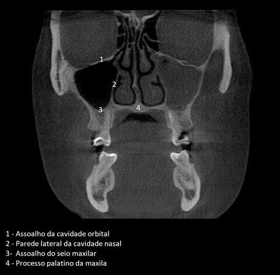 Anatomia da Maxila – Odonto Up