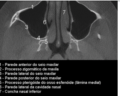 Anatomia da Maxila – Odonto Up