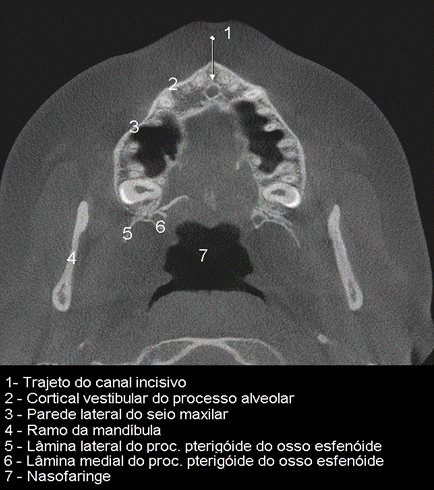 MANDIBULA RADIOPACA COM TODOS OS DENTES PARA CRANIO 9001 - cód. 12285