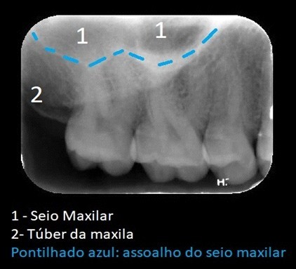 Anatomia da Maxila – Odonto Up