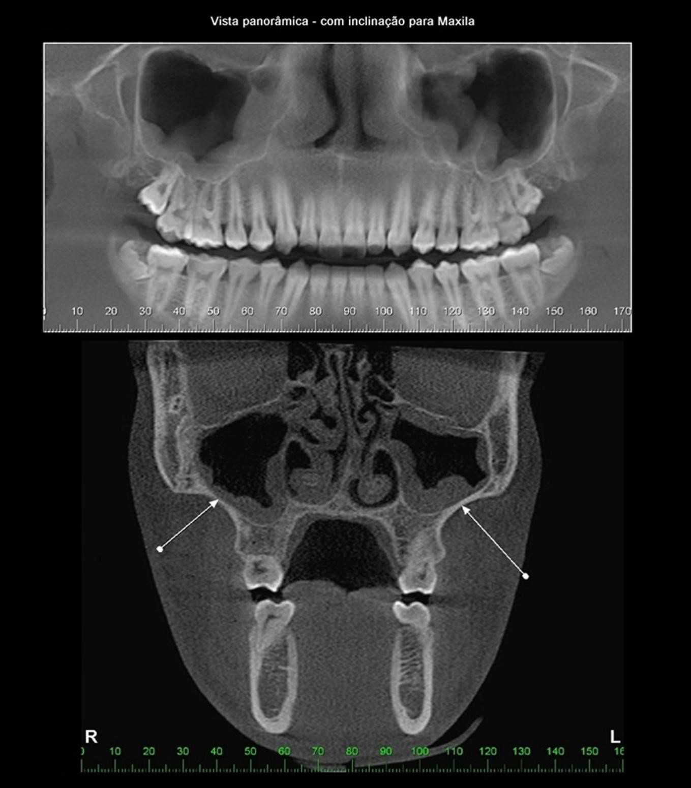 Vista lateral do seio maxilar. (www.lookfordiagnosis.com