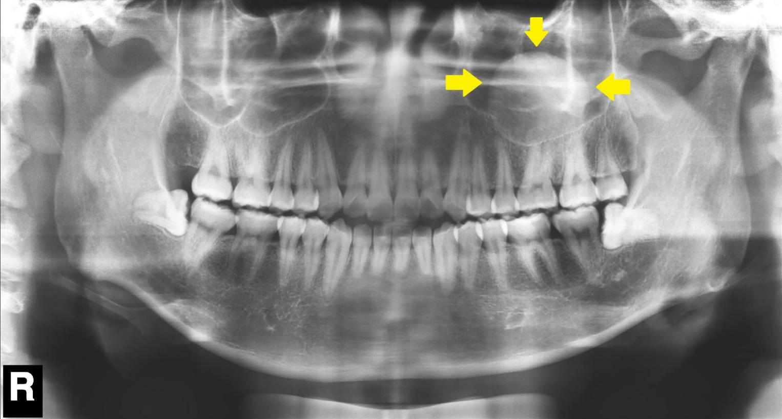Vista lateral do seio maxilar. (www.lookfordiagnosis.com