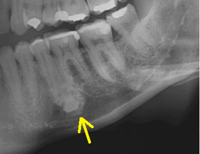 Radiografia Panorâmica da mandíbula não evidencia lesões sugestivas de